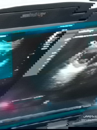 Bun saya hamil 11minggu tapi perut masi biasa aja , sampe ada yg blg org hamil perut nya ga besar2