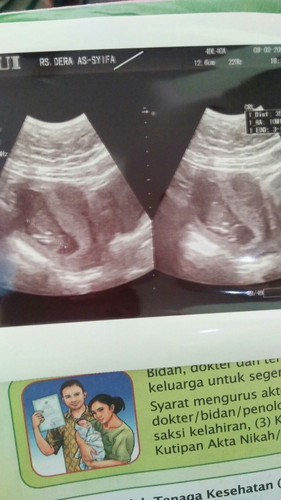 Apa perbedaan mm dan cm di hasil usg