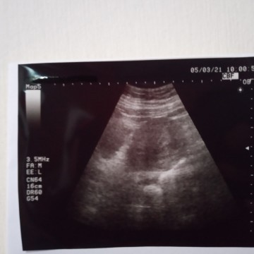 Hasil Usg belum terlihat baru terlihat rahim yang membesar