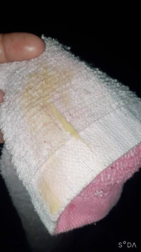 มีน้ำออกสีเหลือง