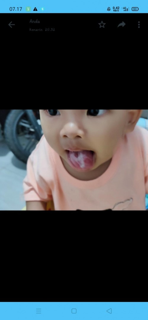 Lidah bayi ada bercaknya