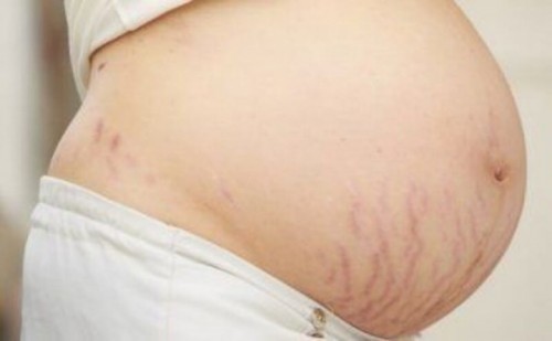 Which type of product helped you prevent stretch marks?