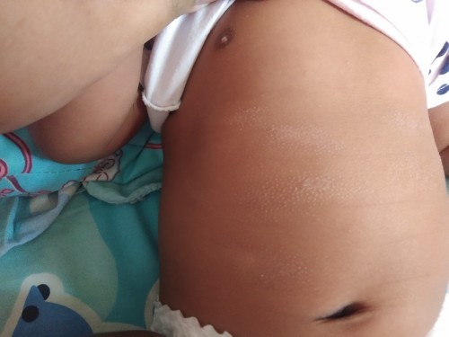 สอบถามค่ะ ลูกมีผิวลอกๆแบบนี้ขึ้นที่หน้าท้อง อยากทราบว่าบ้านไหนเคยเป็นแบบนี้บ้างคะ