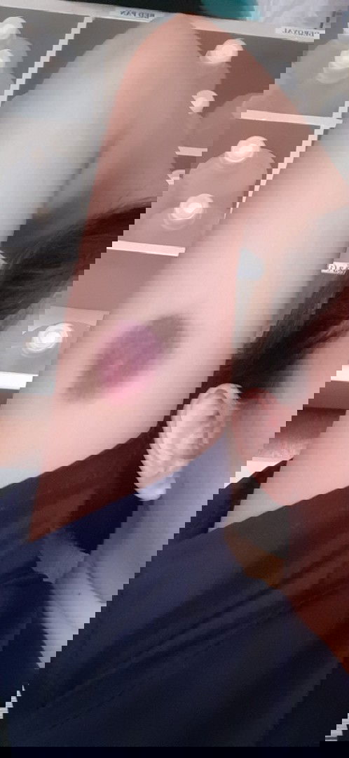 Ask ko lg po.Normal po bang mag ka pasa pag katapos kung mag inject ? Subcu po ang inject .Thanks po