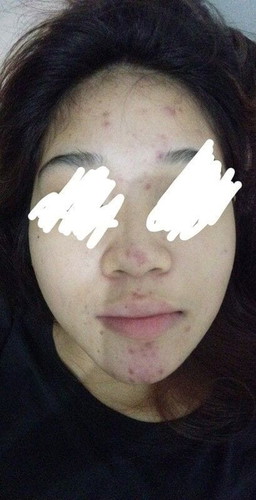 Acne break out during pregnancy🙁