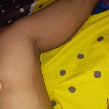 Setelah di urut muncul belang hitam di bagian kaki kanan kiri seperti daki