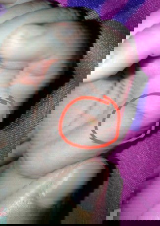 Gigitan & anti nyamuk