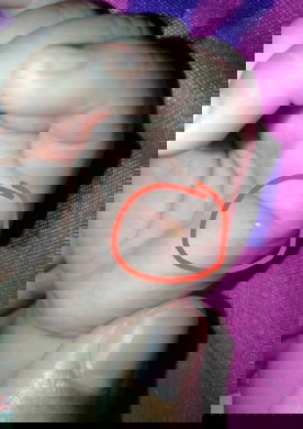 Gigitan & anti nyamuk