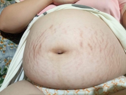 Stretch mark problem