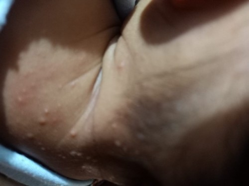 Obat merah2 dileher bayi umur 1 bulan, ada yang tau?