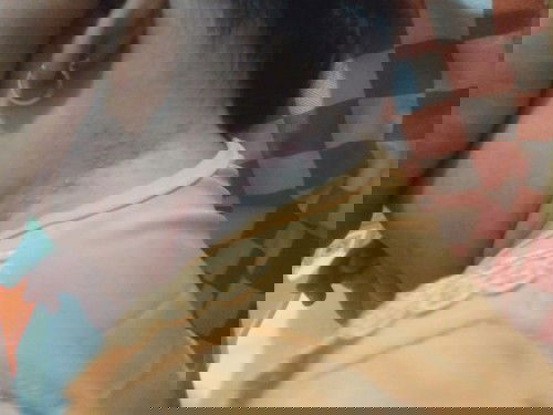 Bé bị lên hột đỏ