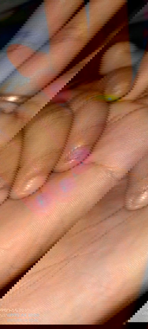 ลูกสาวล้มแล้วนิ้วม่วงเขียวหายแล้วแต่เป็น ฟองในเล็บ อย่างนี้อันตรายมั้ยค่ะ เห็นแล้วสงสานลูกมาก็เลย