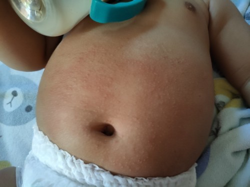น้อง 6 เดือนมีผื่นขึ้นท้อง เป็นผดร้อนหรือแพ้อาหารคะ