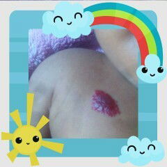 Tanda merah didada bayi