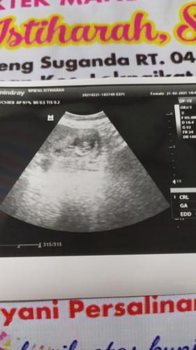 Di usia kandungan 14 minggu,, apa sudah bisa ketahuan jenis kelamin nya