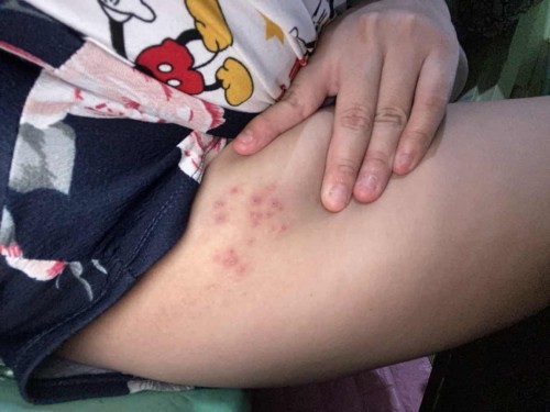 allergies po ba ito?