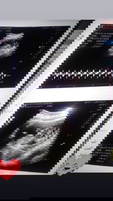 ไปฝากท้องมาแล้วค้าาา🤗💗🤰
ได้แต่รอรู้เพศ.