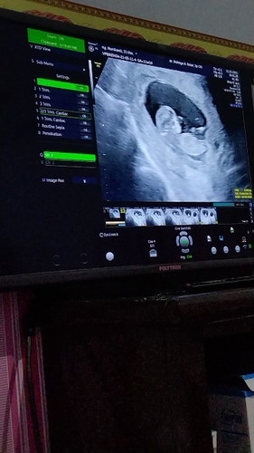 Assalamualaikum Bun saya mau tanya ke Marin zy habis USG dan usia ke hamilan zy bunda sudah memasuki