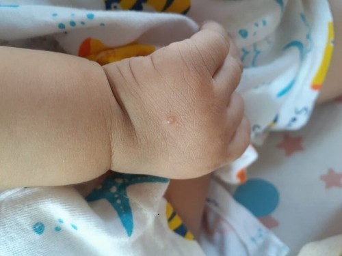 ตุ่มใสบนมือ