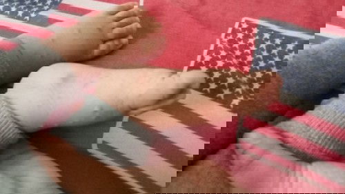 Bentol di muka tangan dan kaki