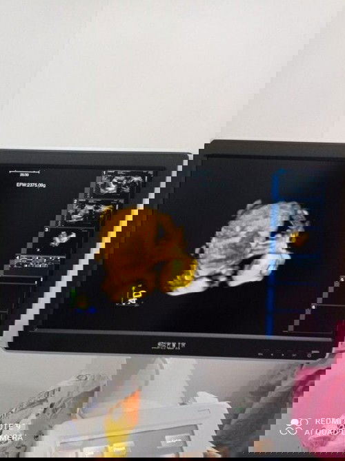 34 week 5 day ( 18 april 2021)