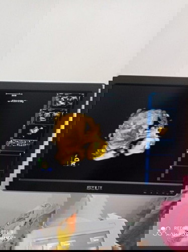 34 week 5 day ( 18 april 2021)