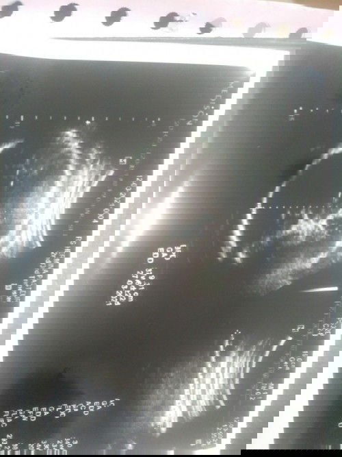 Ketuban Berkurang di kehamilan 40w3d