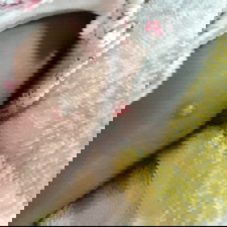 น้องได้1เดือน6วัน ตุ่มมีหนองเพิ่งขึ้นมาต้องดูแลยังไงคะแม่ๆ