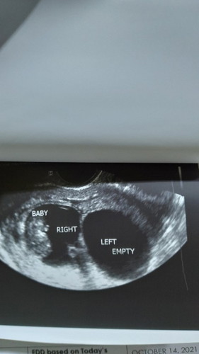 Hi. Meron po bang same case sakin dito? 2 gestational sac pero isa lang po yung nagkaroon ng baby?