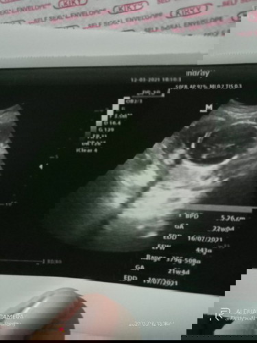MasyaAllah tabarakallah, hbs usg ade bayi yg ke 3x,usia menurut hpht 21wk4dy bbj 443 kira2 normal gk