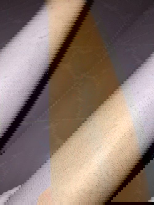 มีแม่ๆคนไหนไหมค่ะ ตอนท้องผื่นขึ้นแบบนี้ ตอนนี้ท้อง 3 เดือนกว่า ผื่นขึ้นและรามไปเรื่อยๆ