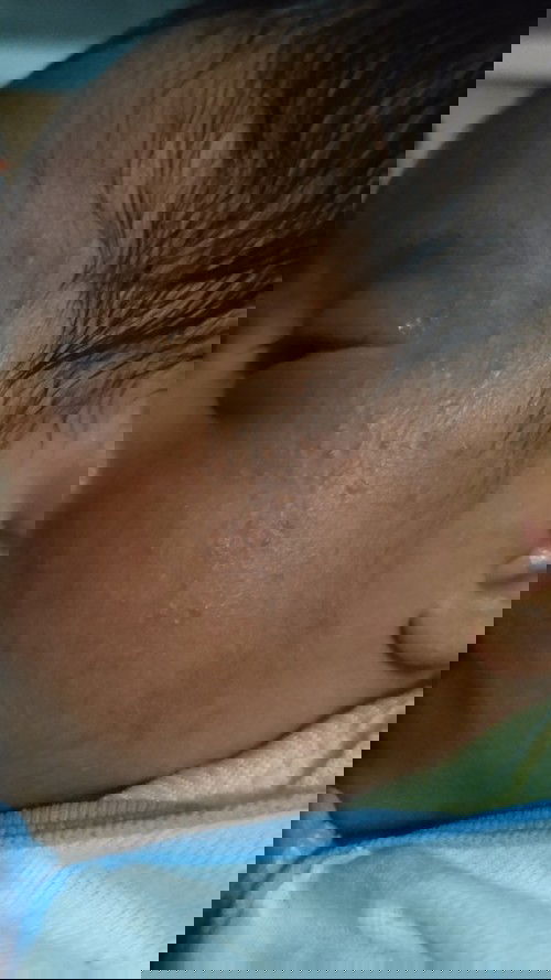 Bintik pada wajah bayi