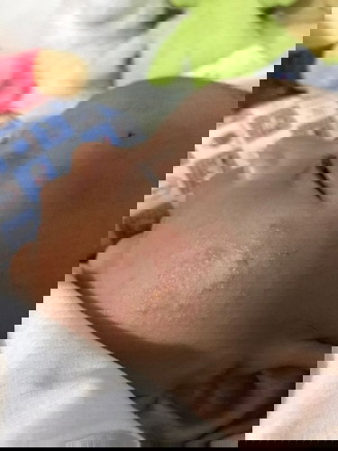 ผดผื่นร้อนขึ้นหน้าและใบหูทั้งสองข้าง