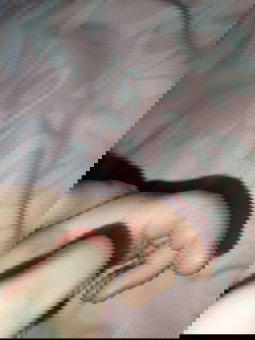 Jari Anak Kena Luka Bakar