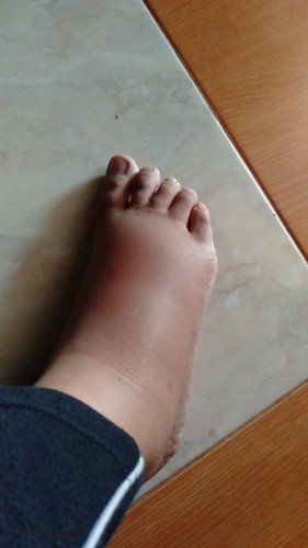 Kaki bengkak. Gimana cara meredakannya ya bun