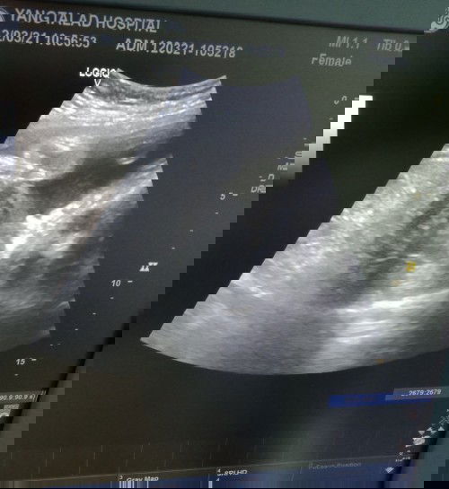 30วีค4วันอยากทราบเพศน้องอะไร