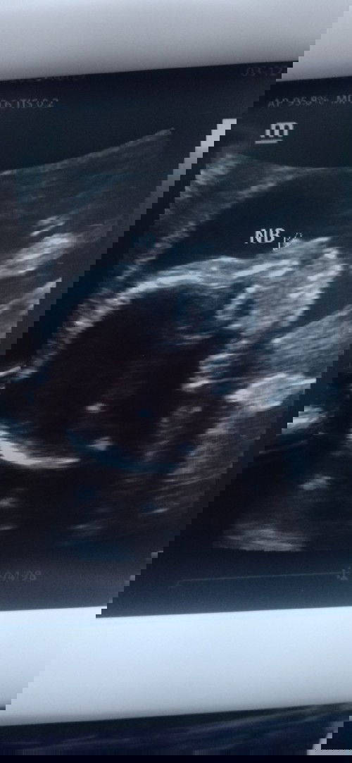 CAS ULTRASOUND @5MONTHS