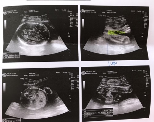 ขอดูน้ำหนักเจ้าตัวน้อย 27 สัปดาห์