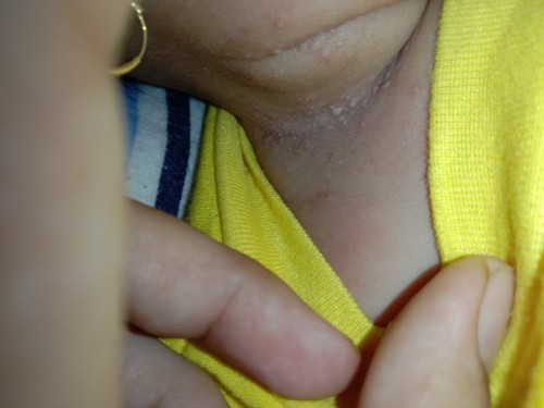 Salep untuk dileher bayi