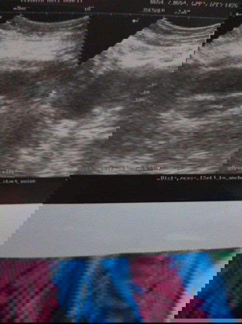 Belum terlihat kantong janin