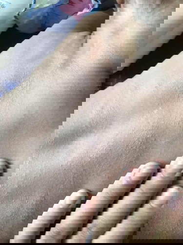 ลูกน้อย 5 เดือน 20 วัน เป้นผื่นขึ้นตรงแผ่นหลัง