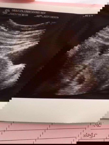 ท้องลม อาการเป็นอย่างไรบ้าง และผลซาวน์นี้เป็นท้องลมไหมคะ