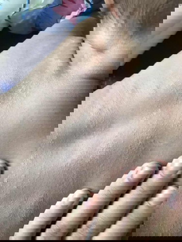 ลูกน้อยเป็นผื่น