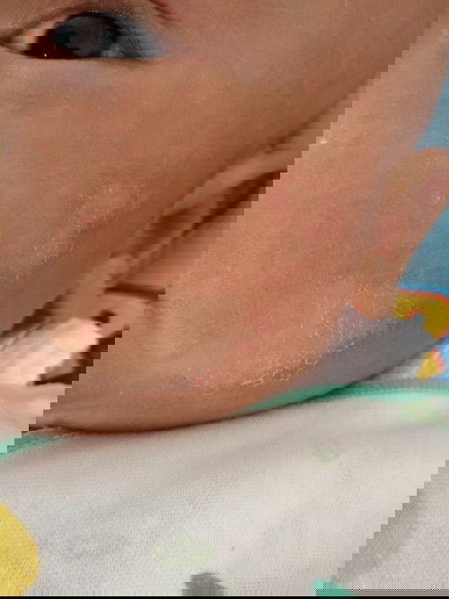 Yang katanya ruam atau karena air susu