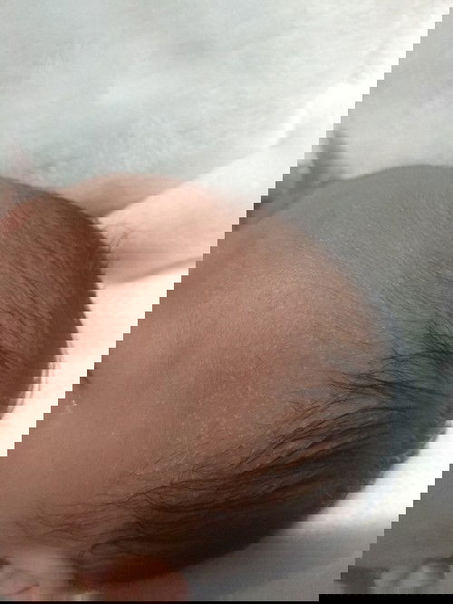 Tanya serius masalah beruntusan