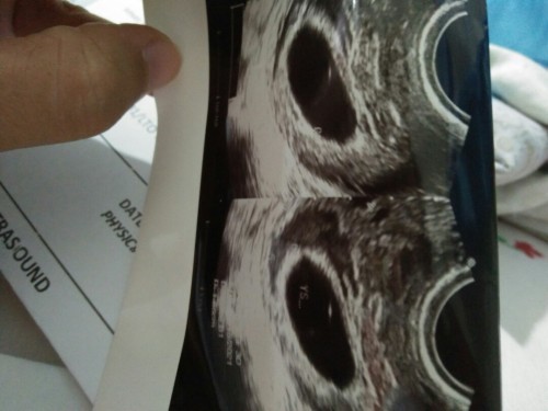 8w 5d na kaya dapat may nKikita ng embryo pero wla 😢 nakakalungkot. 2nd transV ko