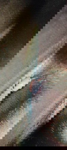 Hemmoroids?