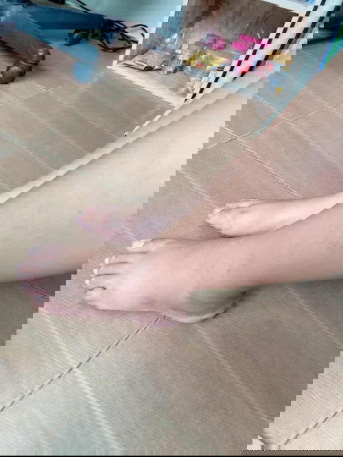 มีอาการเท้าบวมมากกก 😭