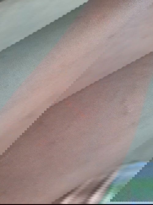 Rashes pede ba ang anti hestamine