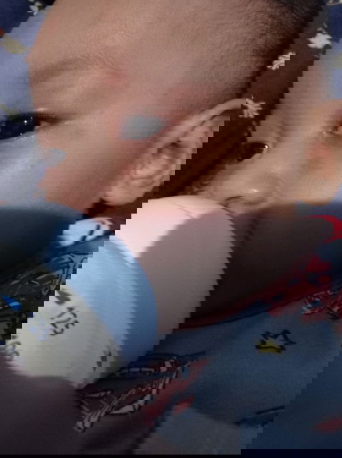 Kemerahan pada wajah bayi